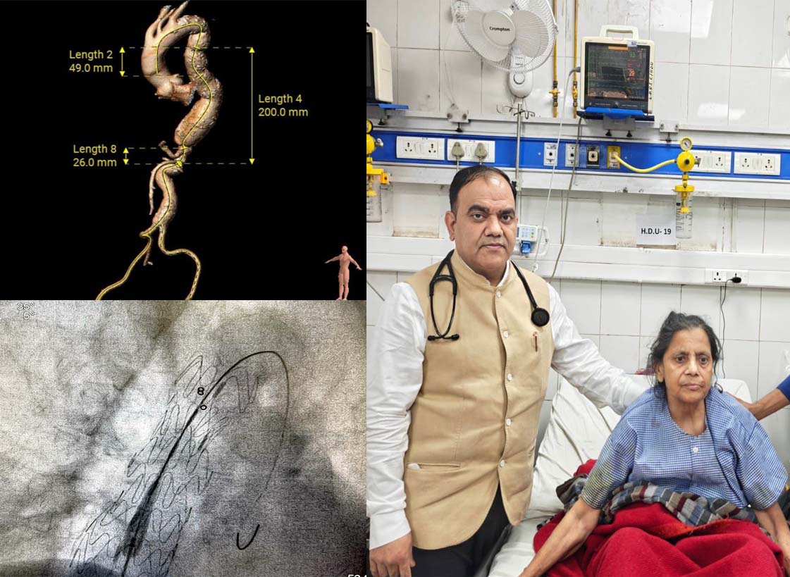 हृदय रोग संस्थान के चिकित्सकों ने गुब्बारा बनी महाधमनी को स्टेंट लगाकर किया ठीक